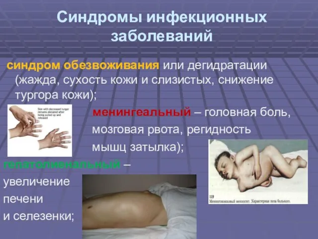 Синдромы инфекционных заболеваний синдром обезвоживания или дегидратации (жажда, сухость кожи и