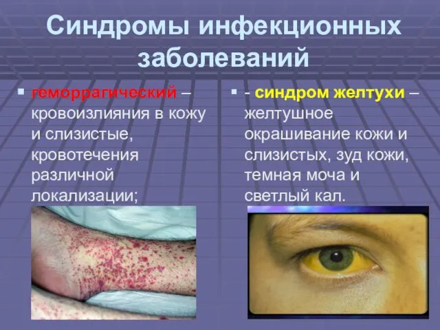 Синдромы инфекционных заболеваний геморрагический – кровоизлияния в кожу и слизистые, кровотечения