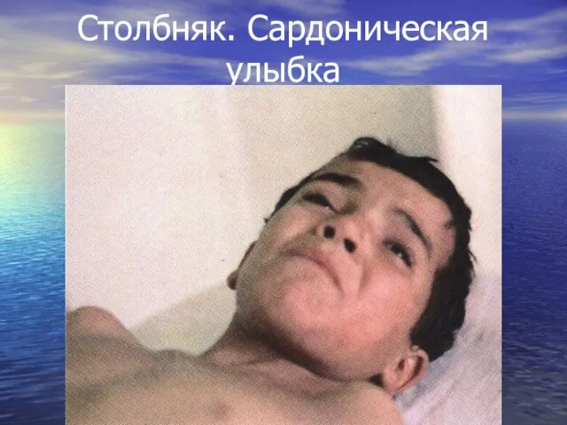 Столбняк. Сардоническая улыбка