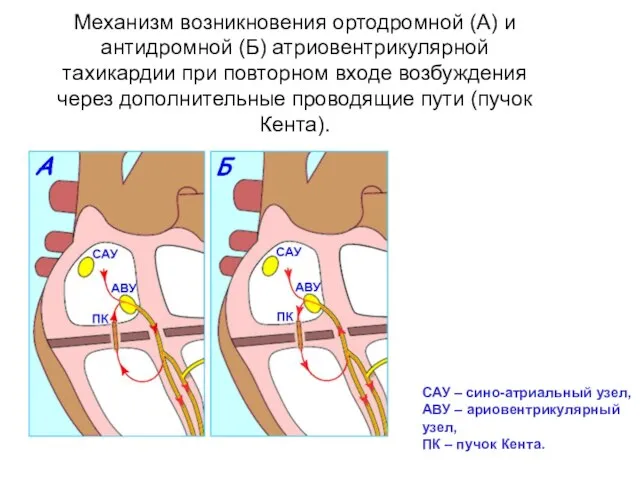 Механизм возникновения ортодромной (А) и антидромной (Б) атриовентрикулярной тахикардии при повторном