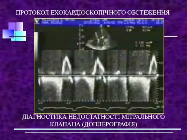 ПРОТОКОЛ ЕХОКАРДІОСКОПІЧНОГО ОБСТЕЖЕННЯ ДІАГНОСТИКА НЕДОСТАТНОСТІ МІТРАЛЬНОГО КЛАПАНА (ДОПЛЕРОГРАФІЯ)