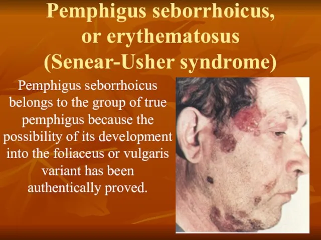 Pemphigus seborrhoicus, or erythematosus (Senear-Usher syndrome) Pemphigus seborrhoicus belongs to the