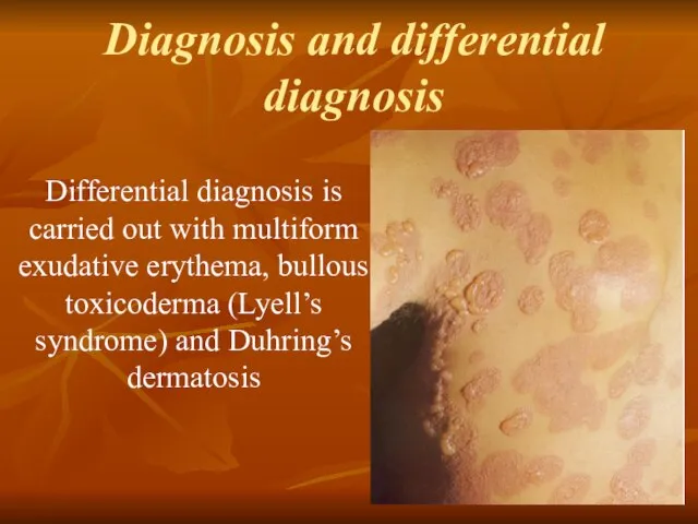 Diagnosis and differential diagnosis Differential diagnosis is carried out with multiform