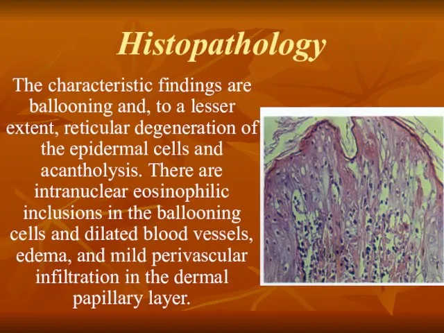 Histopathology The characteristic findings are ballooning and, to a lesser extent,