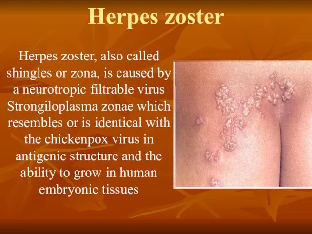 Herpes zoster Herpes zoster, also called shingles or zona, is caused