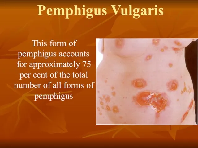 Pemphigus Vulgaris This form of pemphigus accounts for approximately 75 per