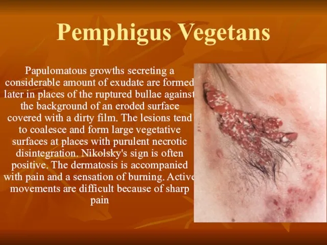 Pemphigus Vegetans Papulomatous growths secreting a considerable amount of exudate are