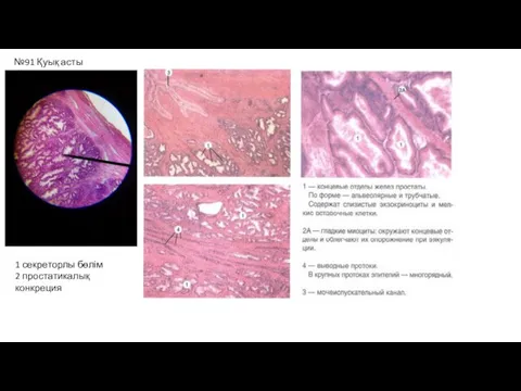 №91 Қуық асты без 1 секреторлы бөлім 2 простатикалық конкреция