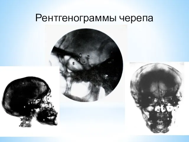 Рентгенограммы черепа