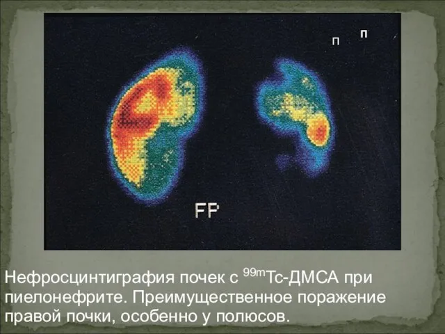 Нефросцинтиграфия почек с 99mTc-ДМСА при пиелонефрите. Преимущественное поражение правой почки, особенно у полюсов. П П