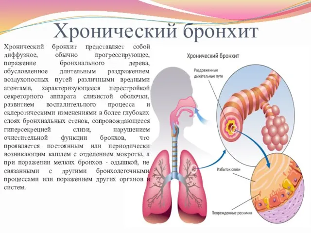 Хронический бронхит Хронический бронхит представляет собой диффузное, обычно прогрессирующее, поражение бронхиального