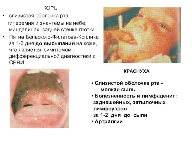 КОРЬ слизистая оболочка рта: гиперемия и энантемы на нёбе, миндалинах, задней