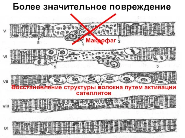 Более значительное повреждение Восстановление структуры волокна путем активации сателлитов Макрофаг