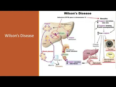 Wilson’s Disease