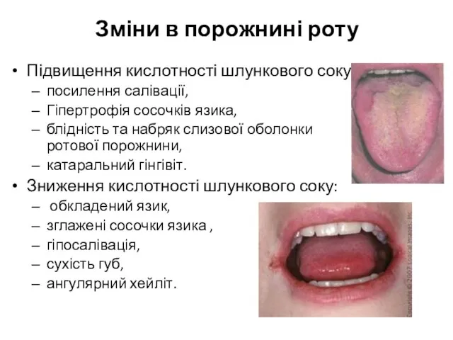 Зміни в порожнині роту Підвищення кислотності шлункового соку: посилення салівації, Гіпертрофія