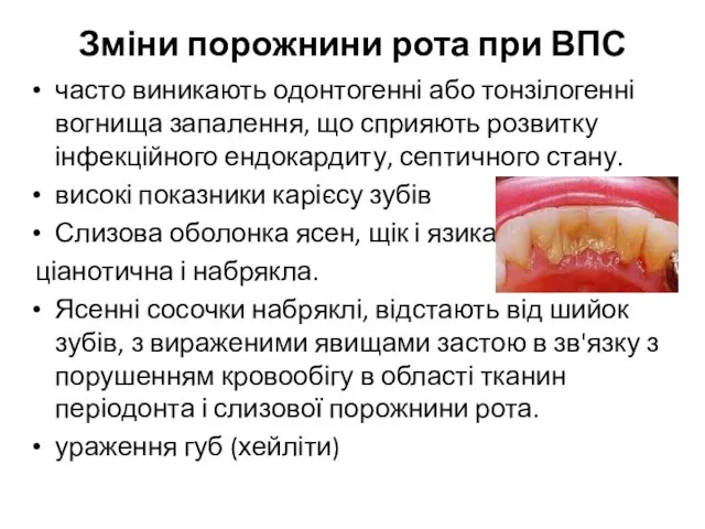 Зміни порожнини рота при ВПС часто виникають одонтогенні або тонзілогенні вогнища