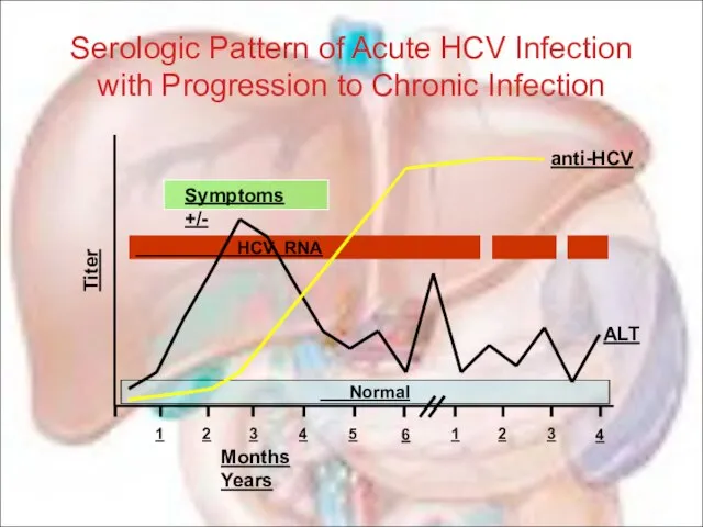 Serologic Pattern of Acute HCV Infection with Progression to Chronic Infection Normal Symptoms +/-