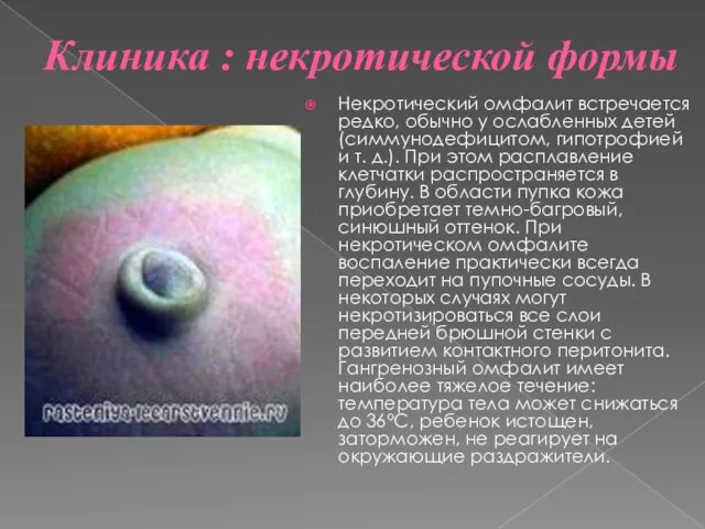 Клиника : некротической формы Некротический омфалит встречается редко, обычно у ослабленных
