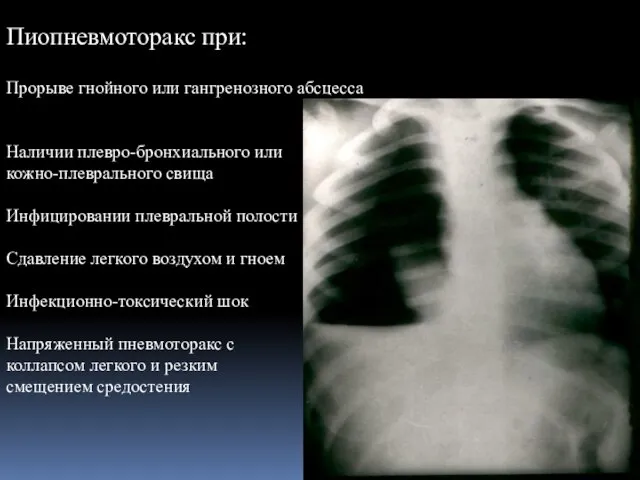 Пиопневмоторакс при: Прорыве гнойного или гангренозного абсцесса Наличии плевро-бронхиального или кожно-плеврального