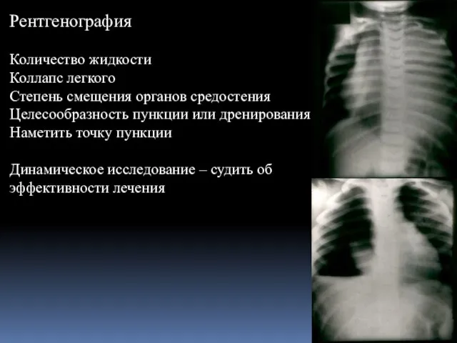 Рентгенография Количество жидкости Коллапс легкого Степень смещения органов средостения Целесообразность пункции