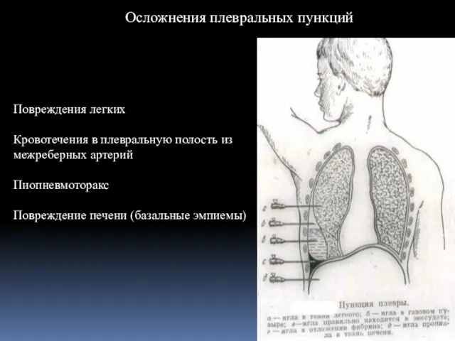 Осложнения плевральных пункций Повреждения легких Кровотечения в плевральную полость из межреберных