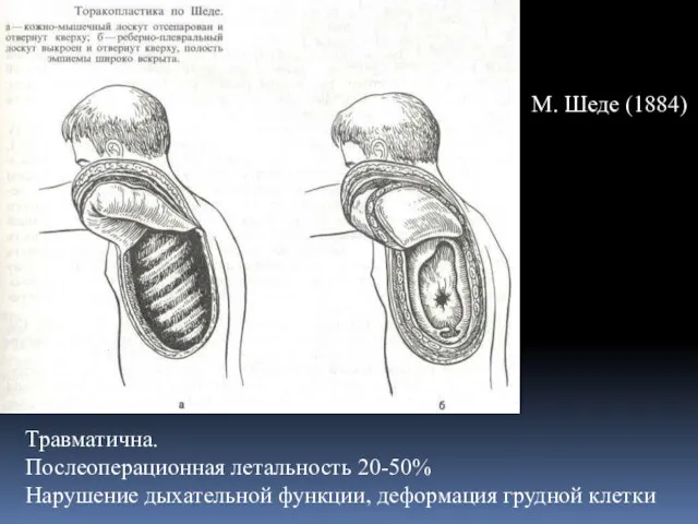 Травматична. Послеоперационная летальность 20-50% Нарушение дыхательной функции, деформация грудной клетки М. Шеде (1884)