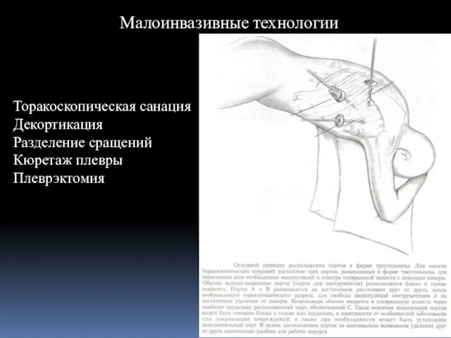 Малоинвазивные технологии Торакоскопическая санация Декортикация Разделение сращений Кюретаж плевры Плеврэктомия