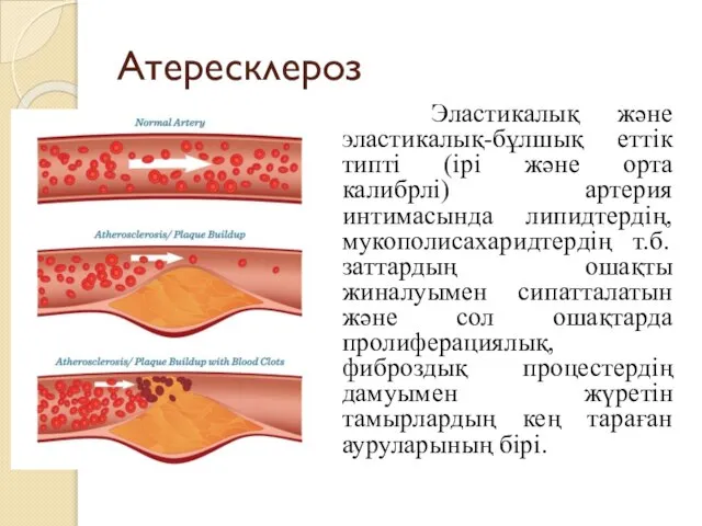 Атересклероз Эластикалық және эластикалық-бұлшық еттік типті (ірі және орта калибрлі) артерия