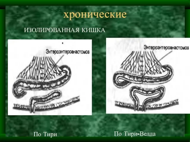 хронические ИЗОЛИРОВАННАЯ КИШКА По Тири По Тири-Велла