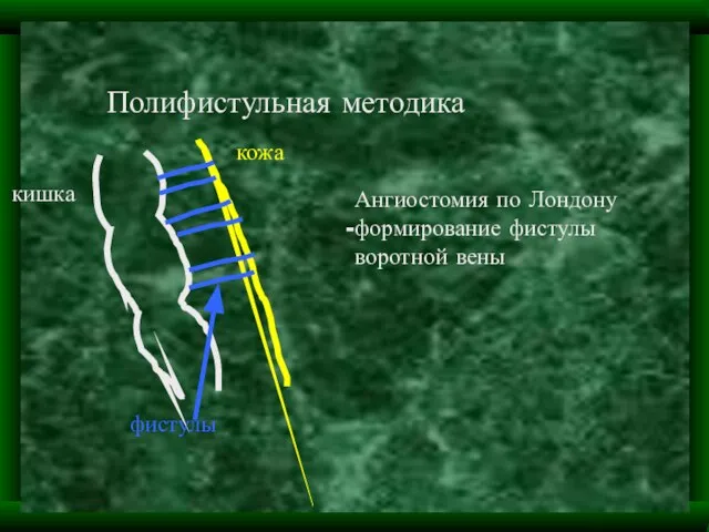 Полифистульная методика кишка кожа фистулы Ангиостомия по Лондону формирование фистулы воротной вены