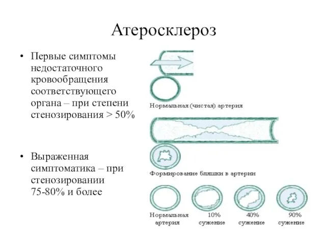 Атеросклероз Первые симптомы недостаточного кровообращения соответствующего органа – при степени стенозирования