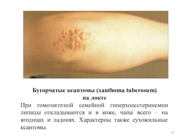 Бугорчатые ксантомы (xanthoma tuberosum) на локте При гомозиготной семейной гиперхолестеринемии липиды