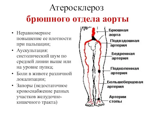 Атеросклероз брюшного отдела аорты Неравномерное повышение ее плотности при пальпации; Аускультация: