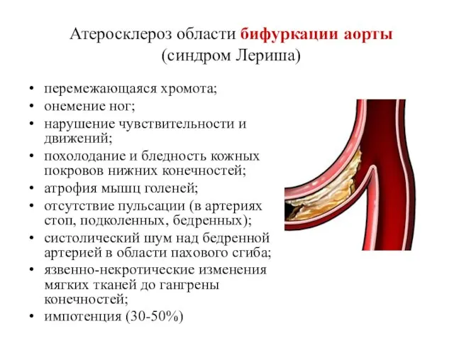 Атеросклероз области бифуркации аорты (синдром Лериша) перемежающаяся хромота; онемение ног; нарушение