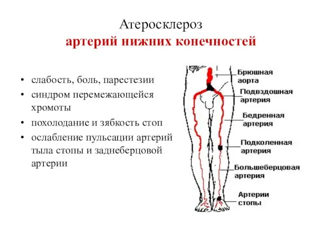 Атеросклероз артерий нижних конечностей слабость, боль, парестезии синдром перемежающейся хромоты похолодание