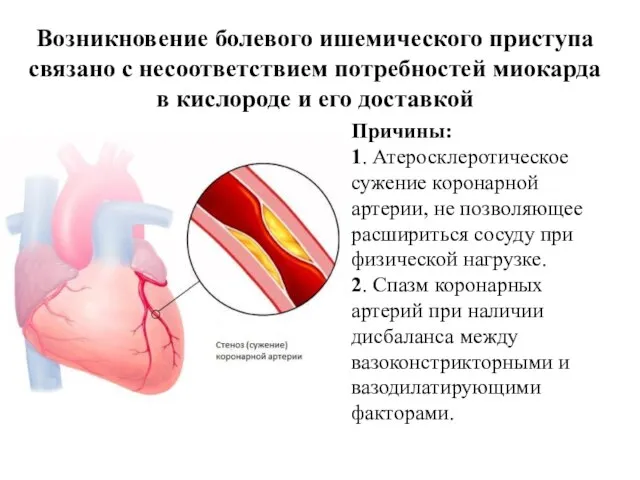 Возникновение болевого ишемического приступа связано с несоответствием потребностей миокарда в кислороде