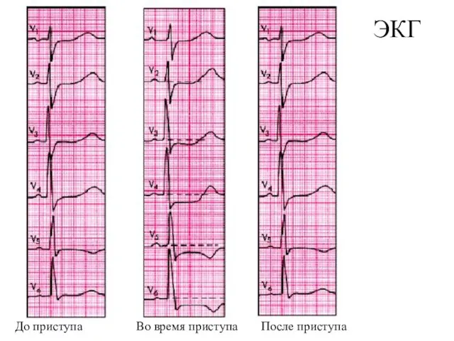 ЭКГ До приступа Во время приступа После приступа