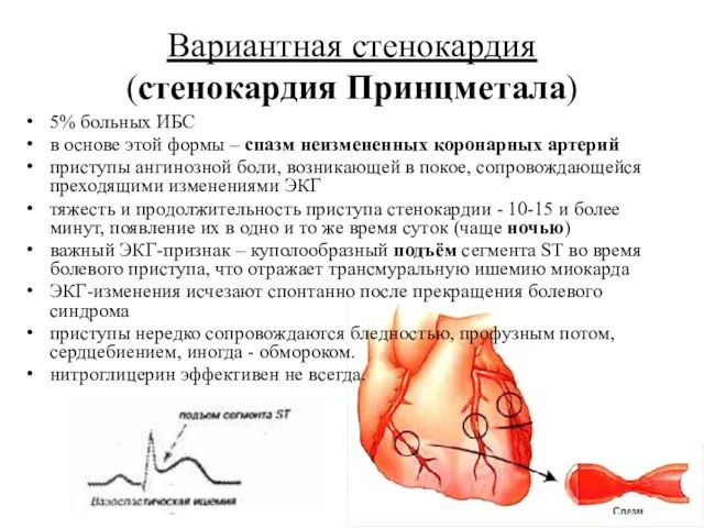 Вариантная стенокардия (стенокардия Принцметала) 5% больных ИБС в основе этой формы