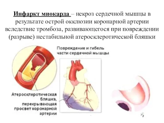 Инфаркт миокарда – некроз сердечной мышцы в результате острой окклюзии коронарной