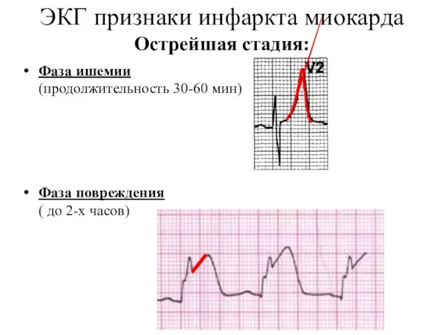 ЭКГ признаки инфаркта миокарда Острейшая стадия: Фаза ишемии (продолжительность 30-60 мин)