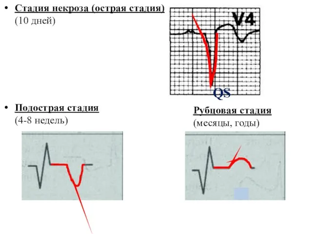 Стадия некроза (острая стадия) (10 дней) Подострая стадия (4-8 недель) Рубцовая стадия (месяцы, годы) QS