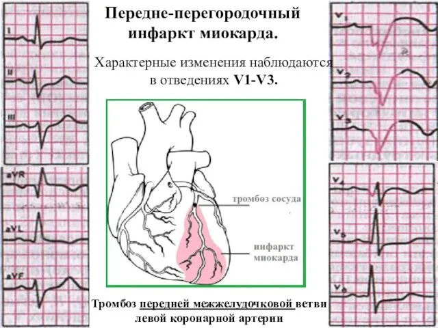 Передне-перегородочный инфаркт миокарда. Характерные изменения наблюдаются в отведениях V1-V3. Тромбоз передней межжелудочковой ветви левой коронарной артерии