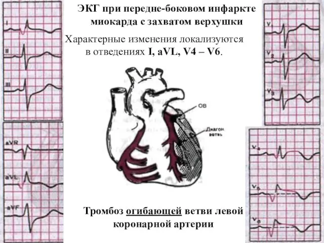 Тромбоз огибающей ветви левой коронарной артерии ЭКГ при передне-боковом инфаркте миокарда