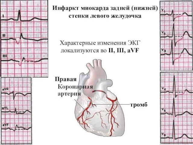 Правая тромб Инфаркт миокарда задней (нижней) стенки левого желудочка Характерные изменения