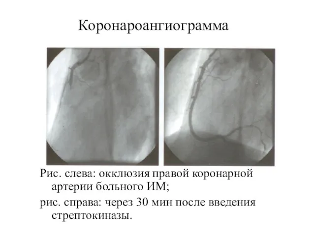Коронароангиограмма Рис. слева: окклюзия правой коронарной артерии больного ИМ; рис. справа: