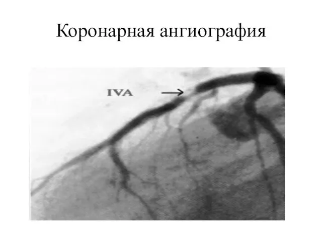 Коронарная ангиография