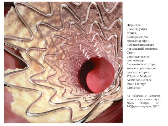 Цифровая реконструкция стента, расширяющего просвет артерии и обеспечивающего нормальный кровоток. Стент