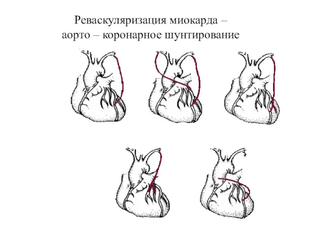 Реваскуляризация миокарда – аорто – коронарное шунтирование