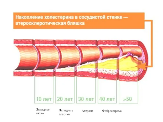 Липидное пятно Липидные полоски Атерома Фиброатерома