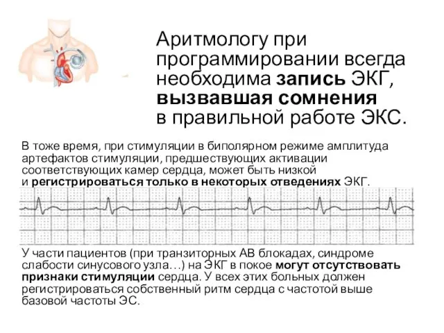 В тоже время, при стимуляции в биполярном режиме амплитуда артефактов стимуляции,